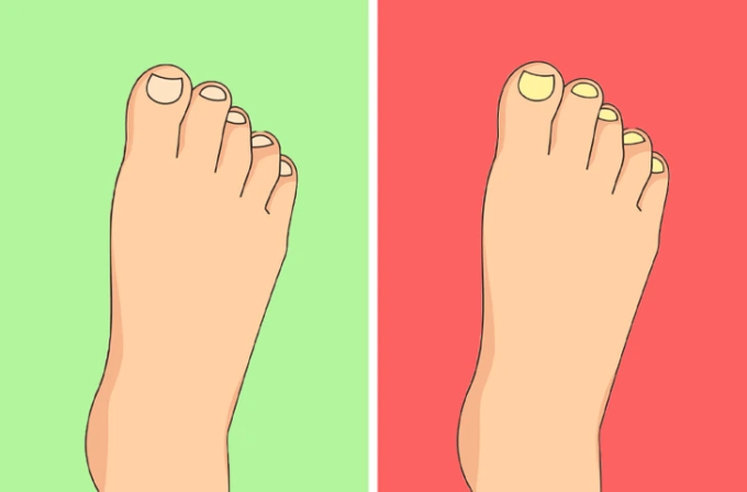 5 Dấu Hiệu Móng Chân Cảnh Báo Bệnh Tật