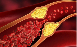 Gầy nhưng vẫn có mỡ máu cao: Nguyên nhân và giải pháp