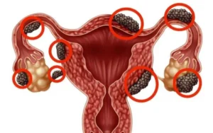 Phụ nữ 47 tuổi ở Bắc Ninh phẫu thuật cắt tử cung do lạc nội mạc tử cung